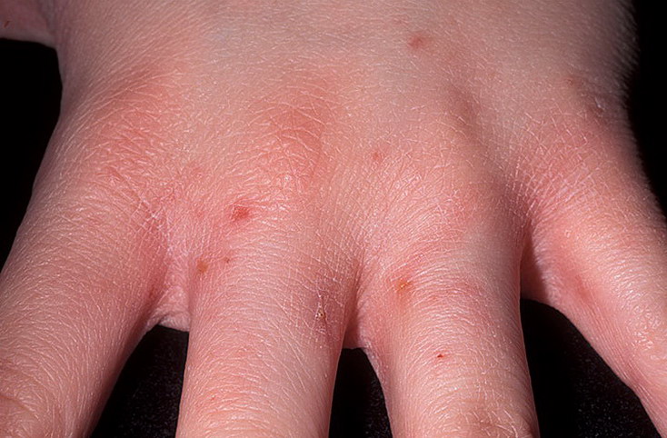 Первые признаки заболевания печени на коже