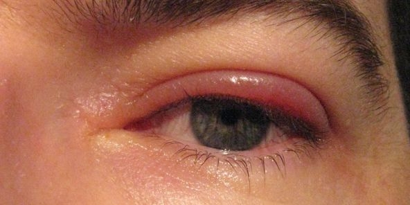 Гомеопатия для сетчатки глаза