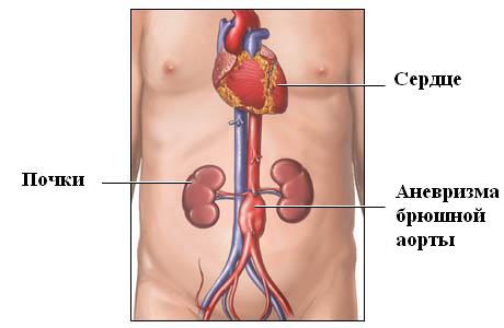 Аорта Брюшной Полости Где Находится Фото