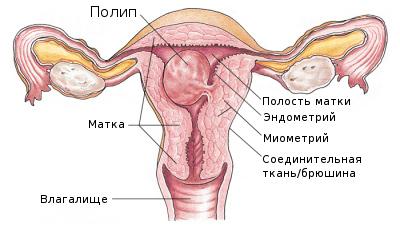Схема расположения полипа матки