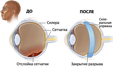 Что такое гомеопатия сетчатки глаза
